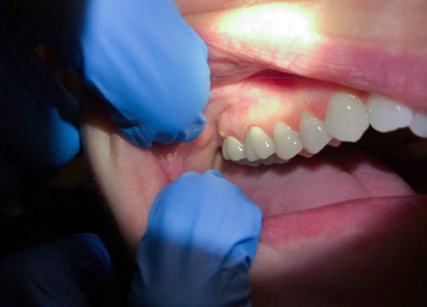 Best Chipped Tooth Repair Near Me  in Philadelphia, MS