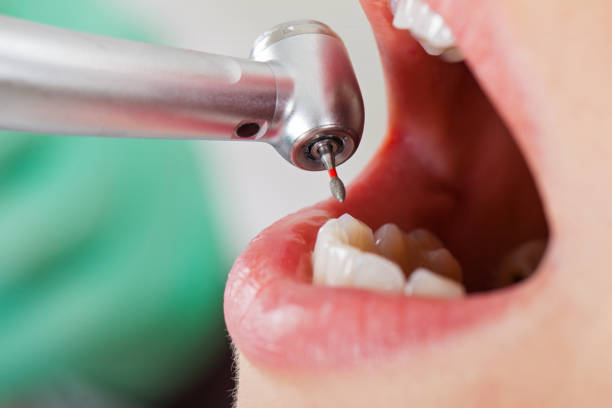 Best Emergency Dental Filling Replacement  in Philadelphia, MS